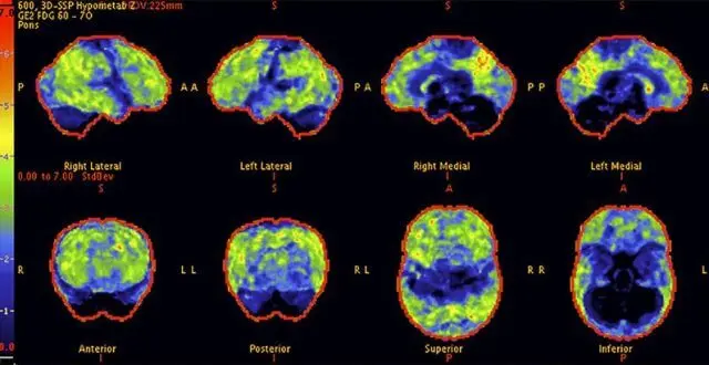 Alzheimer