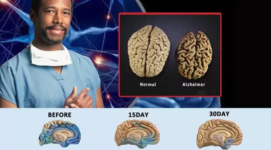 Alzheimer